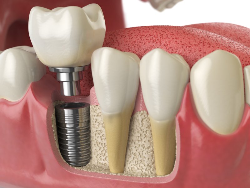 a dental implant